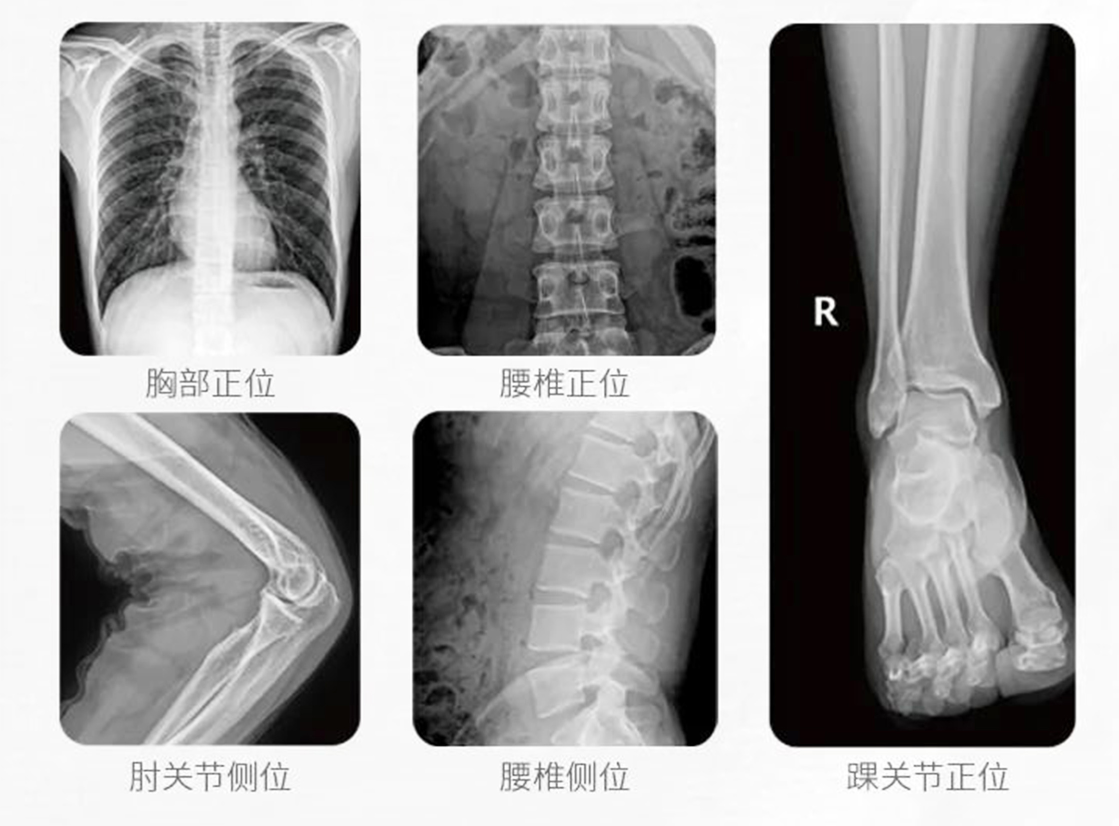 移動式DR臨床影像