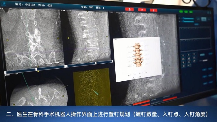 骨科手術機器人和醫生分工2