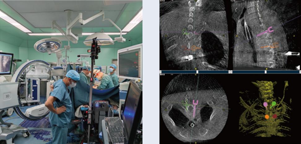 三維C臂與骨科導(dǎo)航機(jī)器人配合應(yīng)用(助力骨科手術(shù)更準(zhǔn)確)