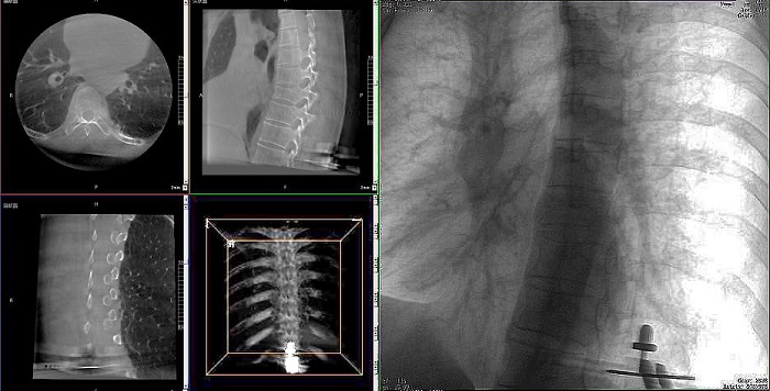 機(jī)器人做胸椎手術(shù)影像