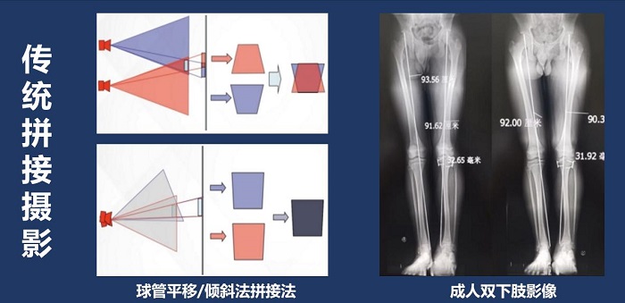 長(zhǎng)骨拼接技術(shù)拍攝全脊柱X光片